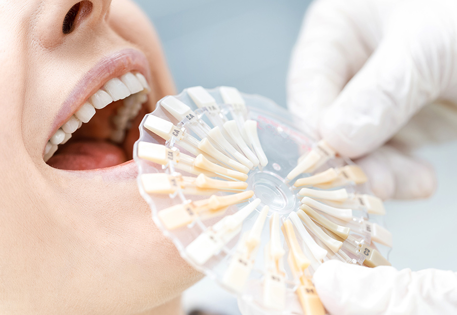 Dental Veneers 14 Dental Veneers in Park Ridge IL